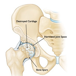 Бедро, пораженное артрозом