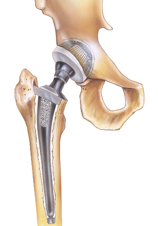 Протез тазобедренного сустава