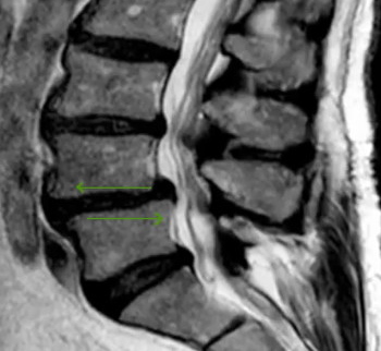 spondolistesi vertebrale: patologia della colonna vertebrale