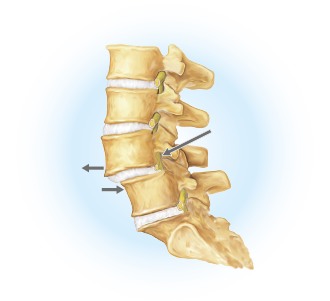 spondolistesi vertebrale: patologia della colonna vertebrale