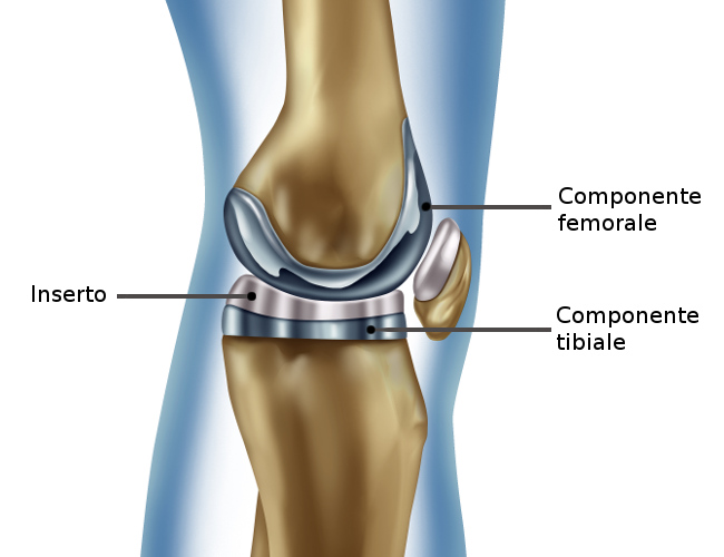 Protesi ginocchio