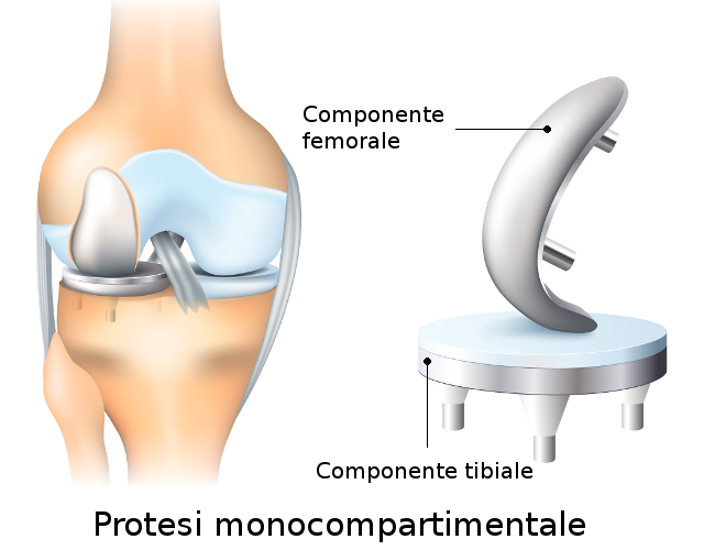 Protesi monocompartimentale al ginocchio