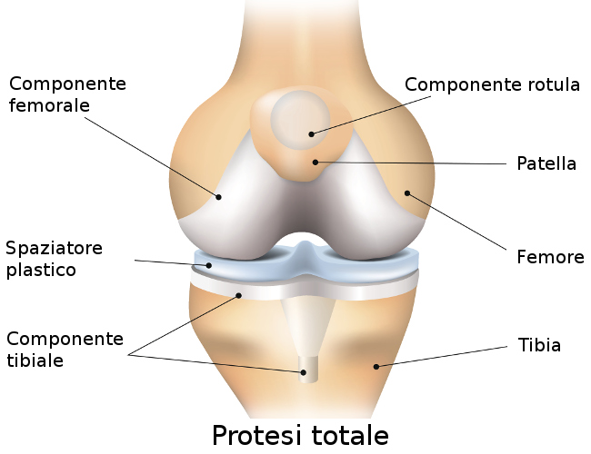 Protesi totale al ginocchio