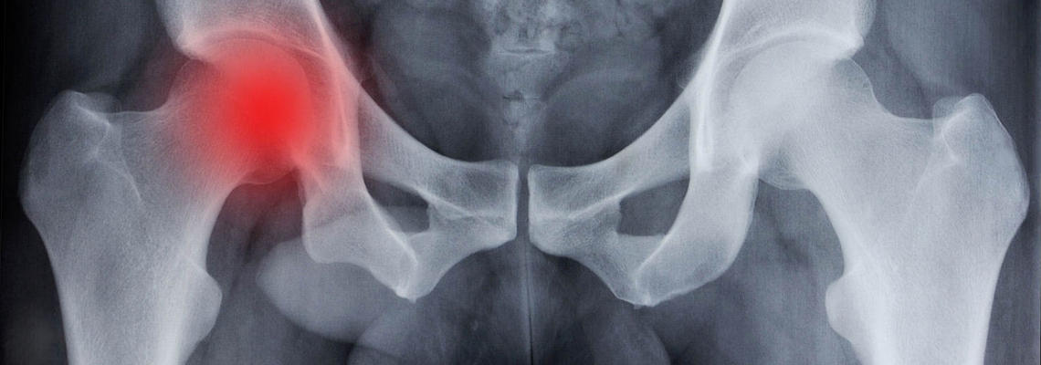 Chirurgia ortopedica anca - dolore