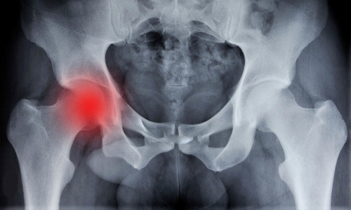 Chirurgia ortopedica anca - dolore