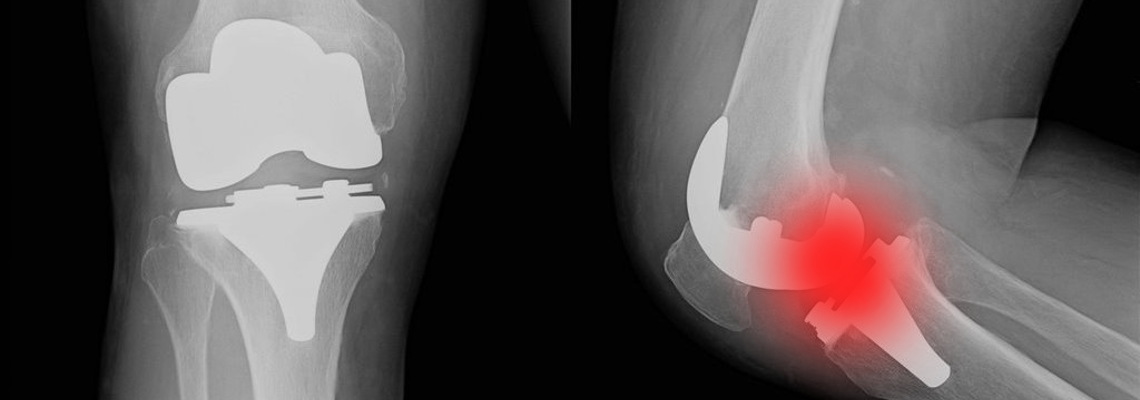 Chirurgia ortopedica ginocchio - dolore