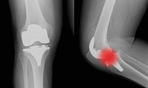 Chirurgia ortopedica ginocchio - dolore