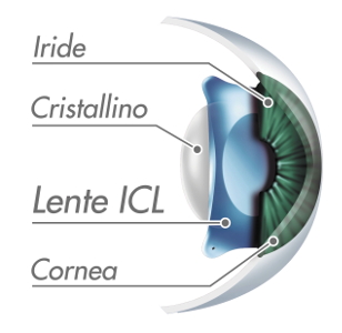 Lenti ICL