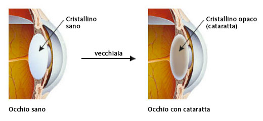 Confronto cristallino sano e opaco