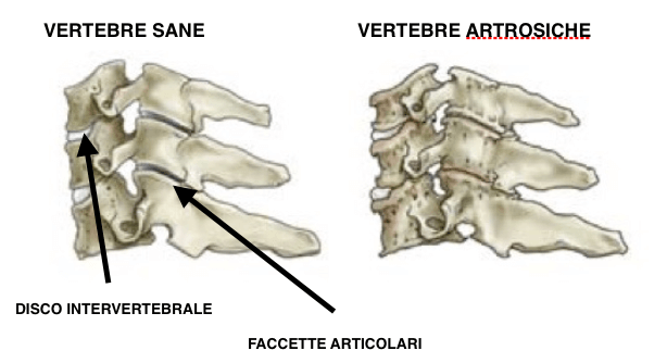 vertebre sane e artrosiche